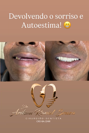 Antes e depois de transformação do sorriso