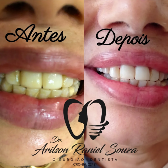 Antes e depois de reabilitação do sorriso